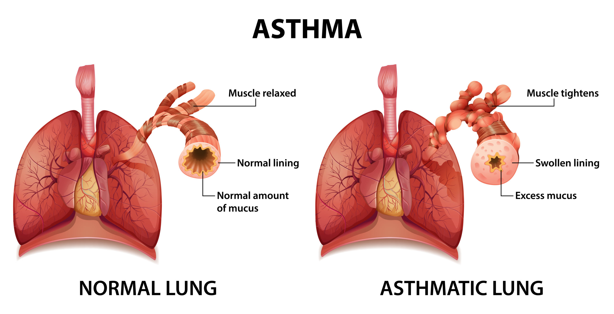 Asthma Wheezing: All you need to know about it